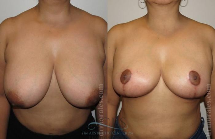 Before & After Breast Reduction Case 1190 Front View: View in Houston, TX