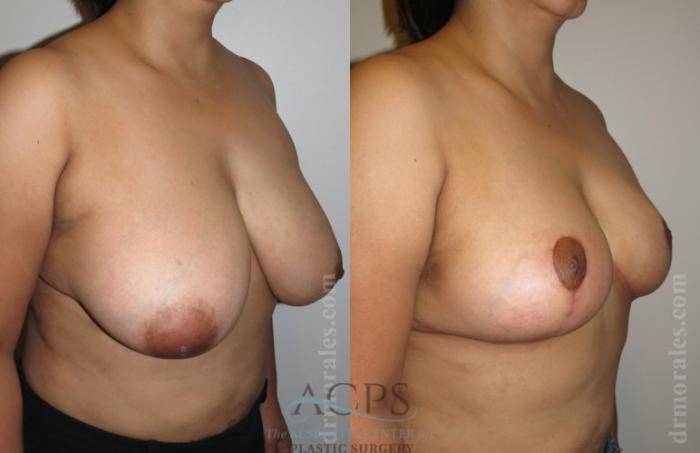 Before & After Breast Reduction Case 1190 Oblique View: View in Houston, TX