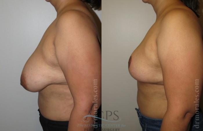 Before & After Breast Reduction Case 1190 Side View: View in Houston, TX