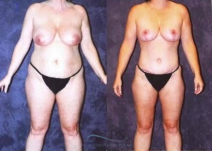 Before & After Breast Reduction Case 1191 Front View: View in Houston, TX