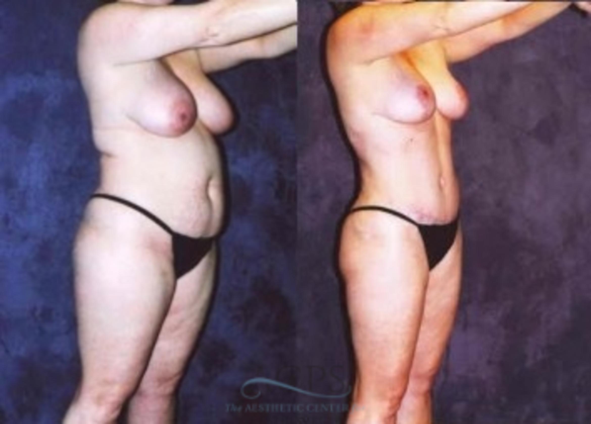 Before & After Breast Reduction Case 1191 Oblique View: View in Houston, TX