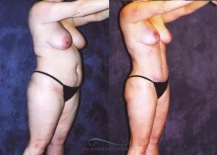 Before & After Breast Reduction Case 1191 Oblique View: View in Houston, TX