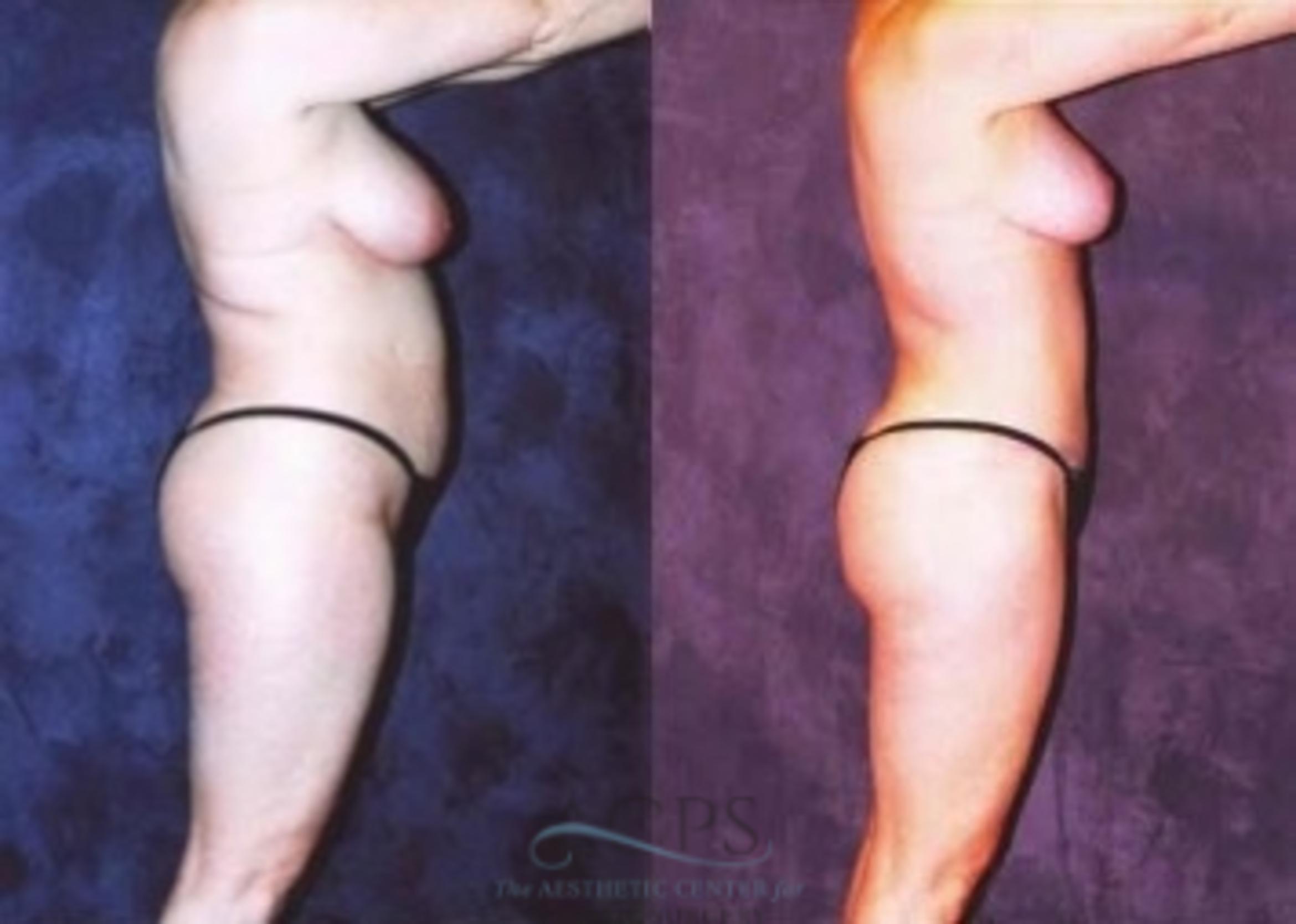 Before & After Breast Reduction Case 1191 Side View: View in Houston, TX