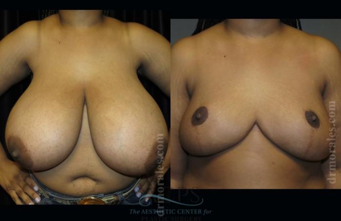 Before & After Breast Reduction Case 1192 Front View: View in Houston, TX