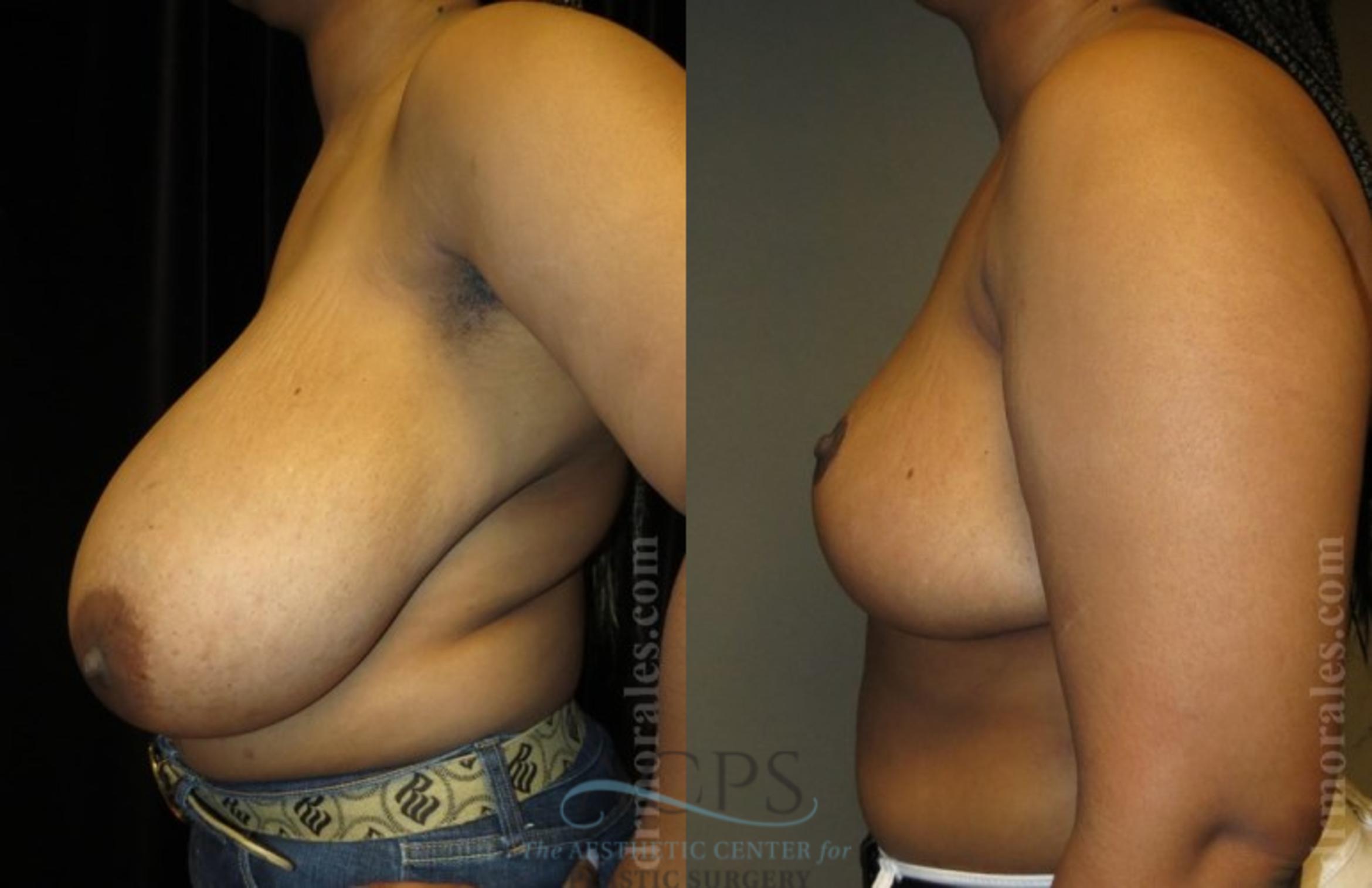 Before & After Breast Reduction Case 1192 Side View: View in Houston, TX