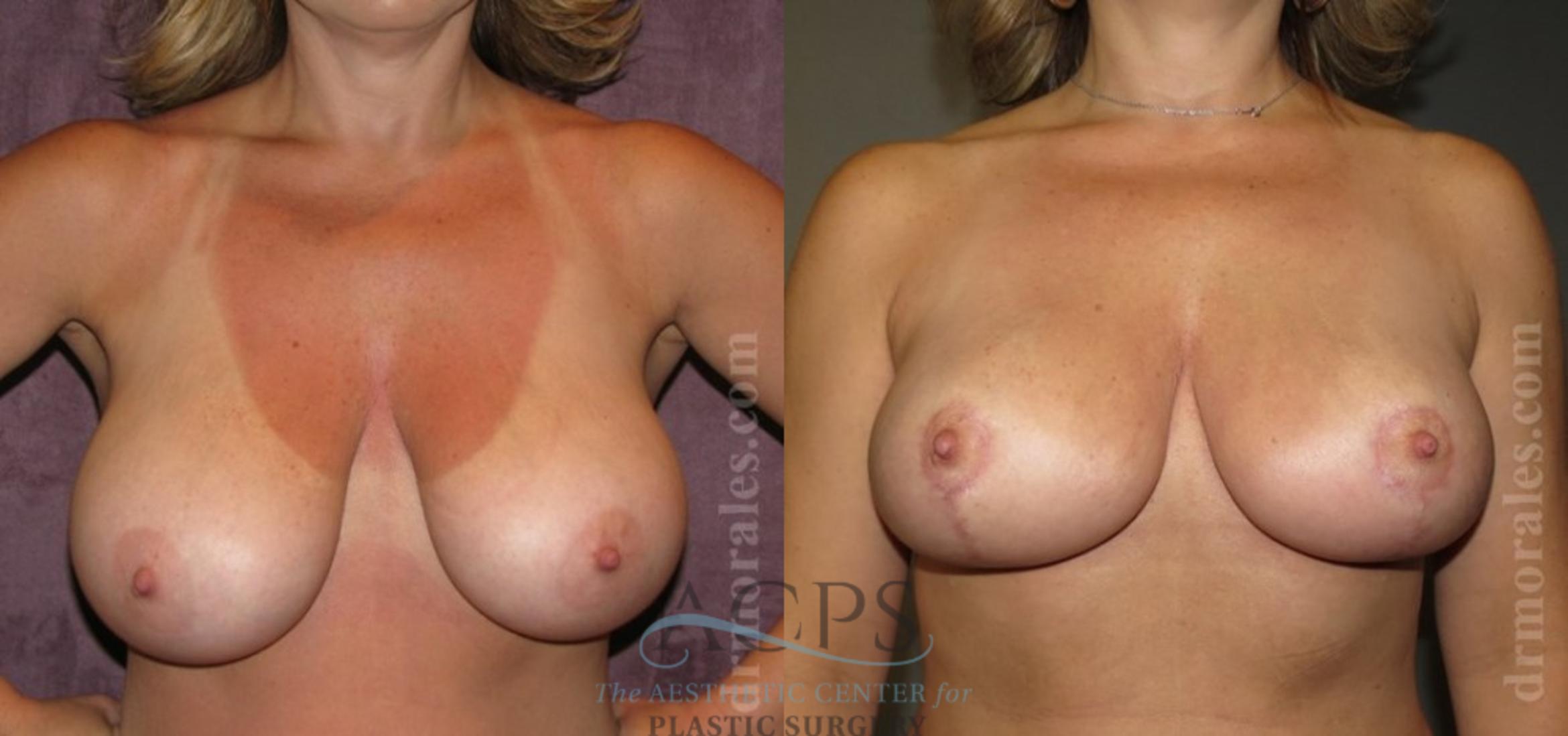 Before & After Breast Reduction Case 1193 Front View: View in Houston, TX