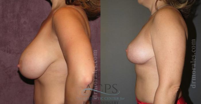 Before & After Breast Reduction Case 1193 Side View: View in Houston, TX