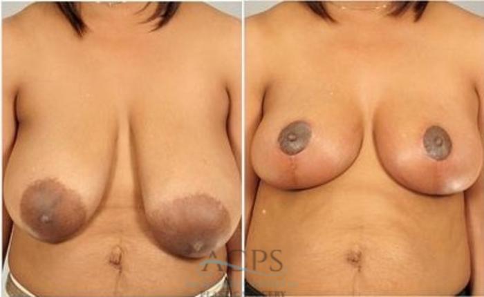 Before & After Breast Reduction Case 1194 Front View: View in Houston, TX