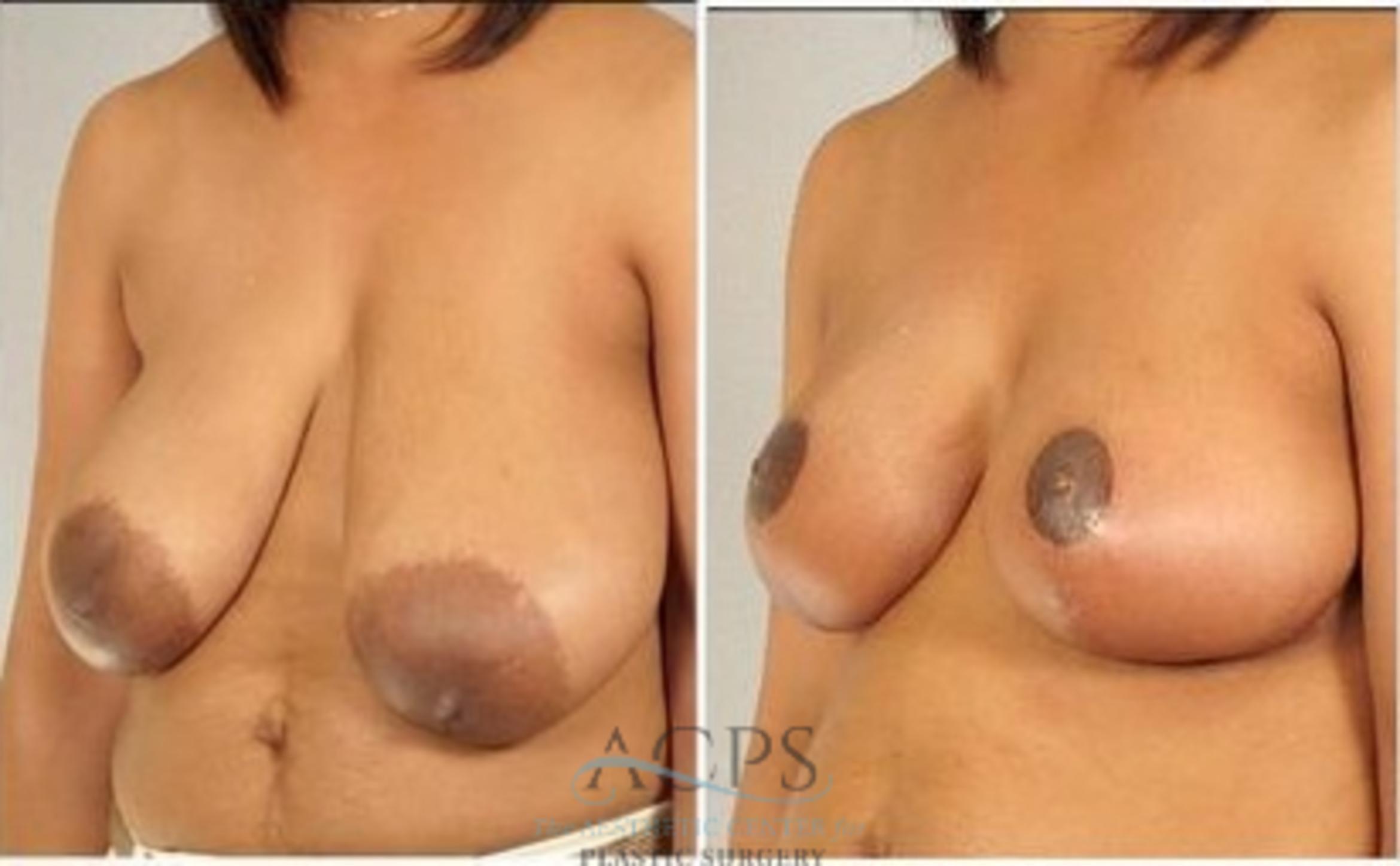 Before & After Breast Reduction Case 1194 Oblique View: View in Houston, TX