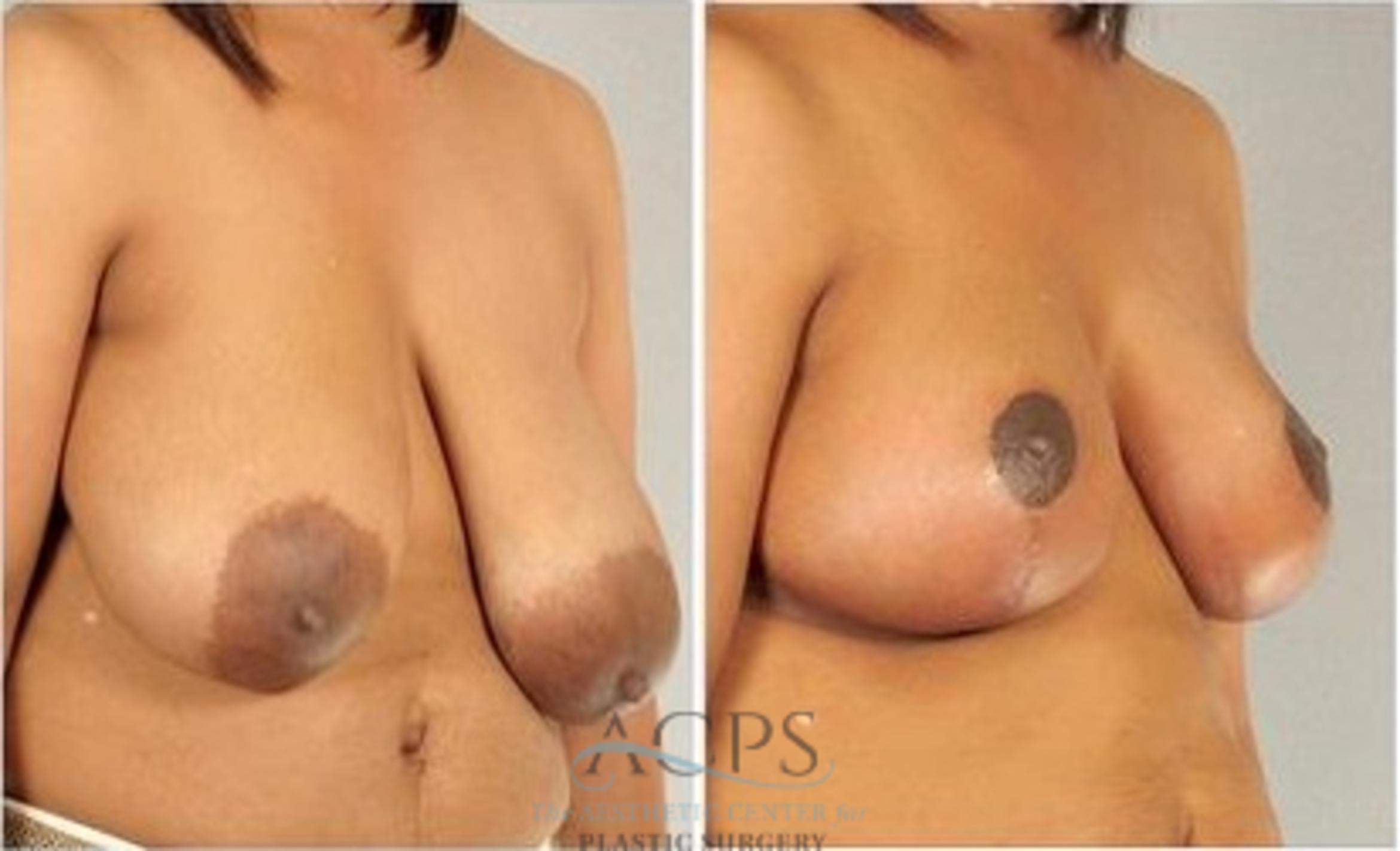 Before & After Breast Reduction Case 1194 Side View: View in Houston, TX
