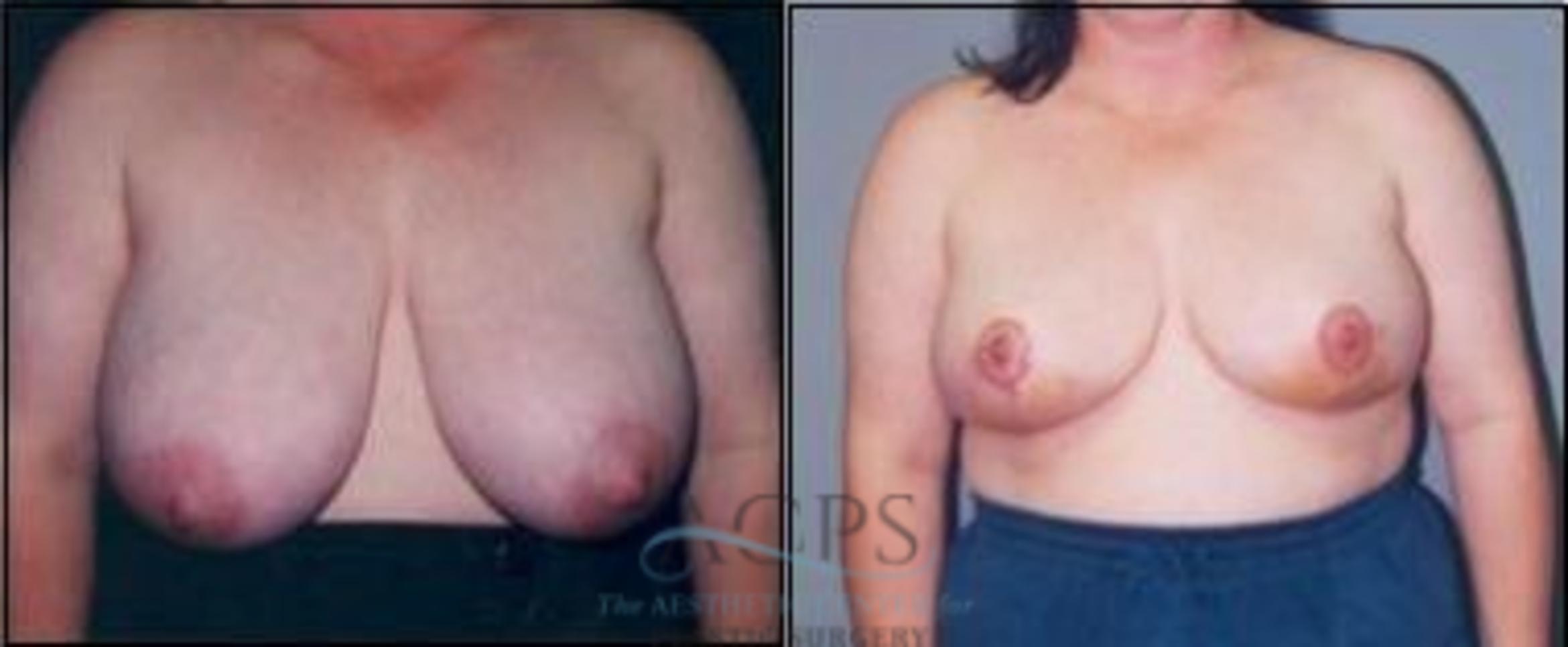 Before & After Breast Reduction Case 1195 Front View: View in Houston, TX