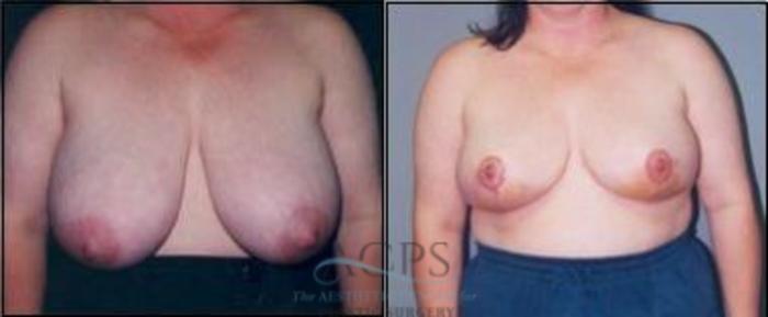 Before & After Breast Reduction Case 1195 Front View: View in Houston, TX