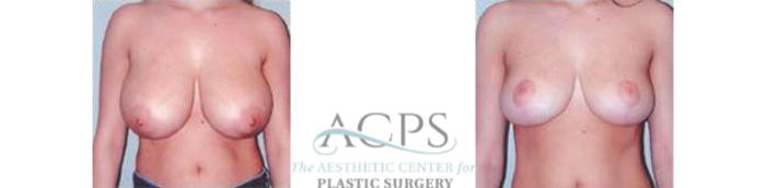 Before & After Breast Reduction Case 1196 Front View: View in Houston, TX