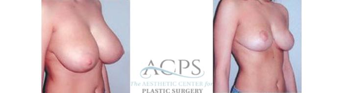 Before & After Breast Reduction Case 1196 Oblique View: View in Houston, TX