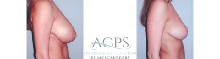 Before & After Breast Reduction Case 1196 Side View: View in Houston, TX