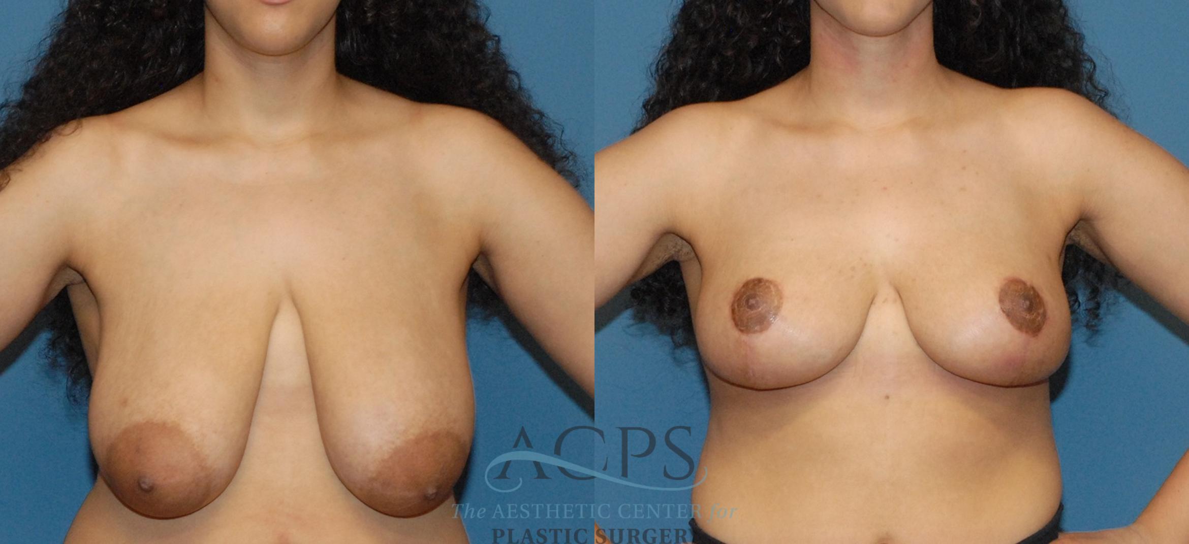 Before & After Breast Lift Case 1541 Front View in Houston, TX
