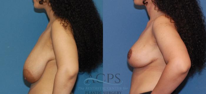 Before & After Breast Lift Case 1541 Left Side View in Houston, TX