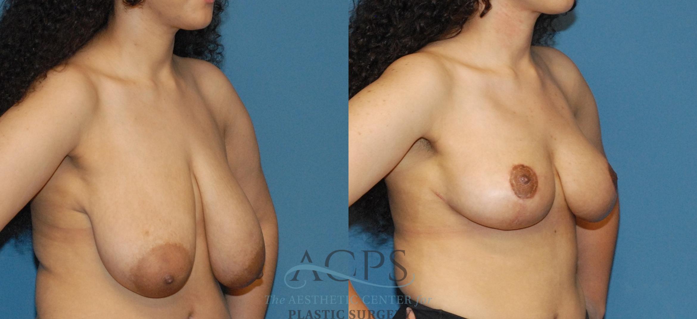 Before & After Breast Lift Case 1541 Right Oblique View in Houston, TX