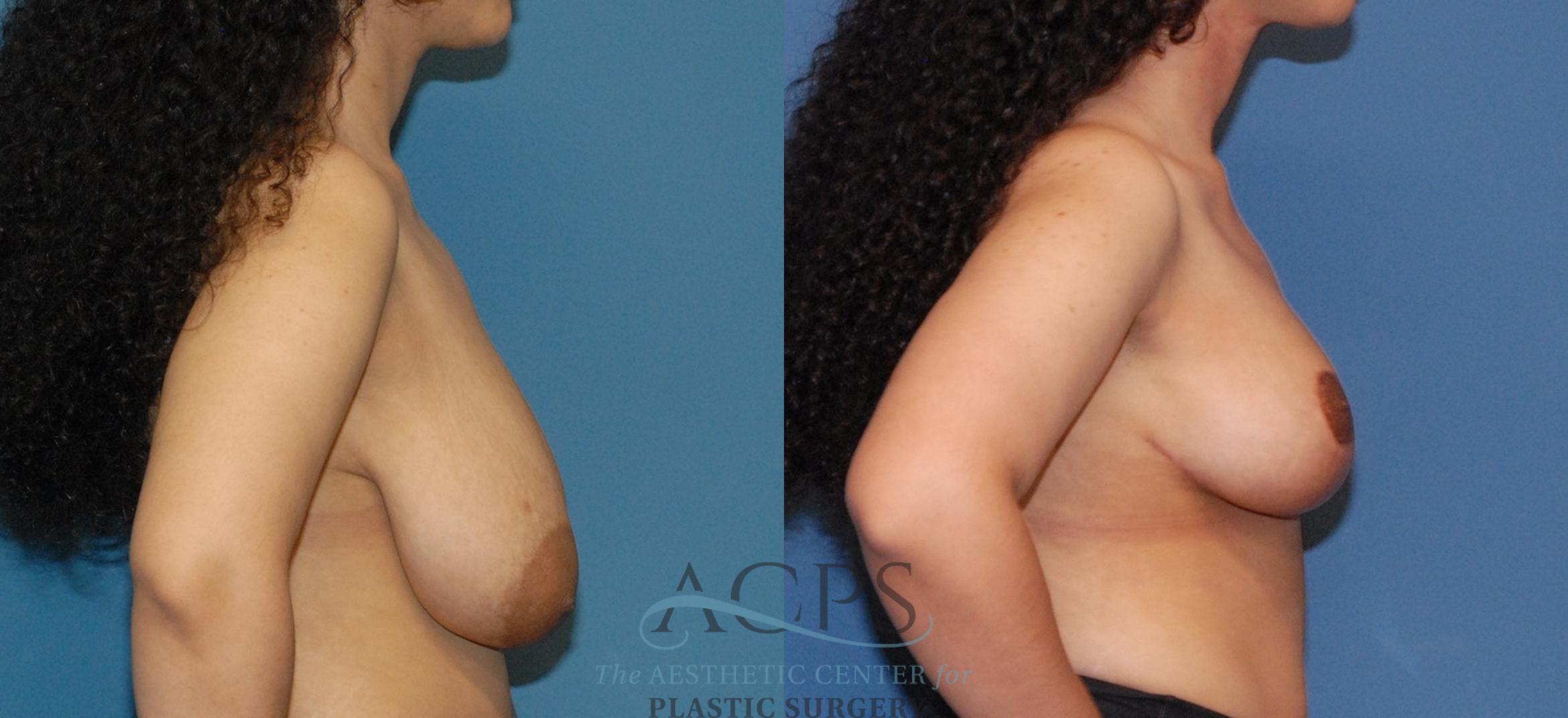 Before & After Breast Lift Case 1541 Right Side View in Houston, TX