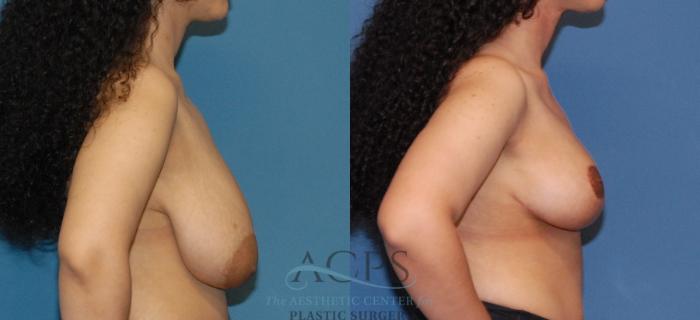 Before & After Breast Lift Case 1541 Right Side View in Houston, TX
