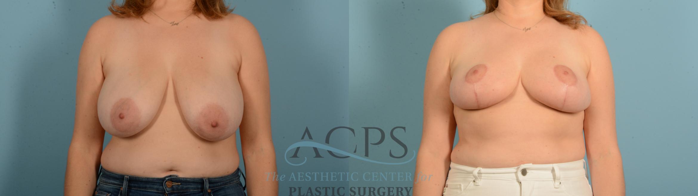 Before & After Breast Reduction Case 1543 Front View in Houston, TX