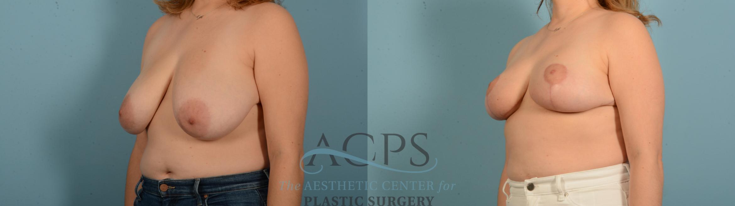 Before & After Breast Reduction Case 1543 Left Oblique View in Houston, TX