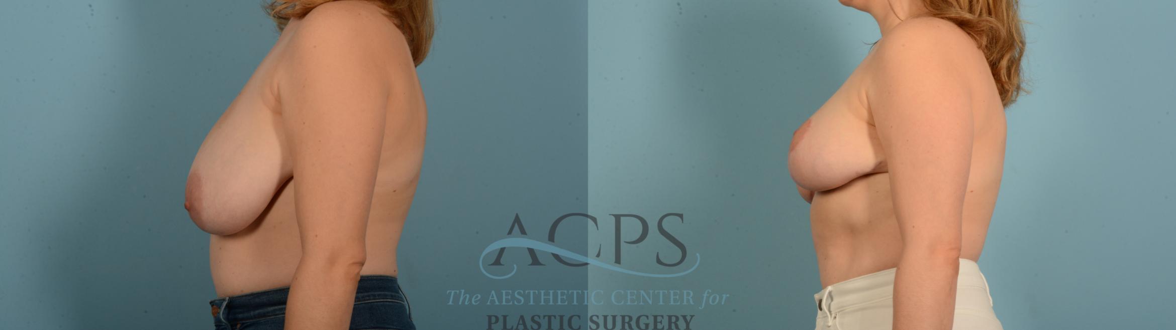 Before & After Breast Reduction Case 1543 Left Side View in Houston, TX