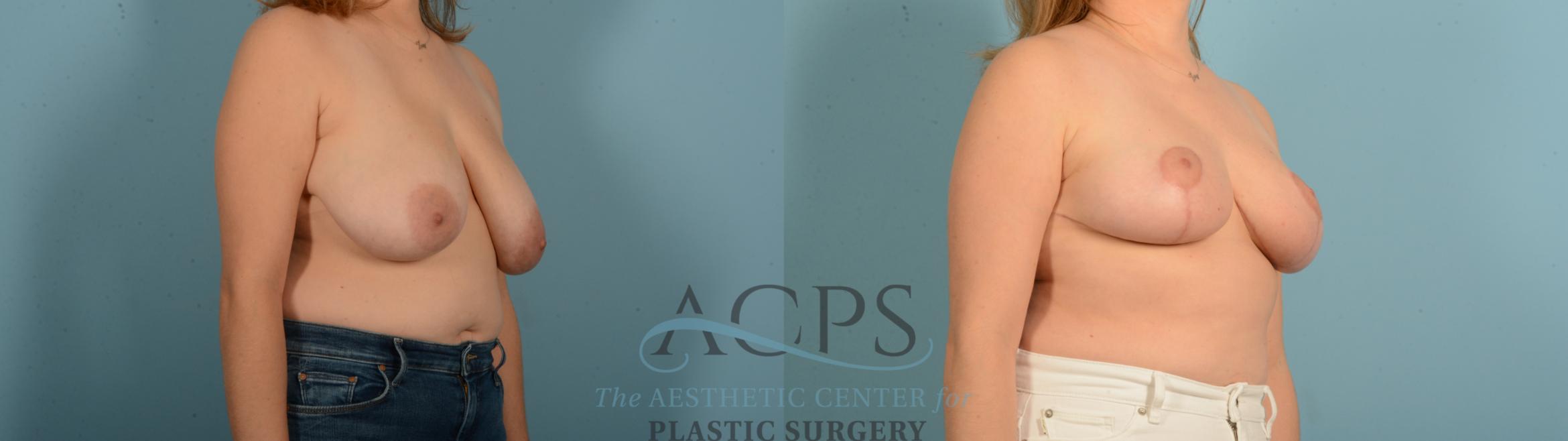 Before & After Breast Reduction Case 1543 Right Oblique View in Houston, TX