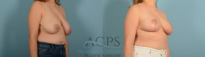 Before & After Breast Reduction Case 1543 Right Oblique View in Houston, TX