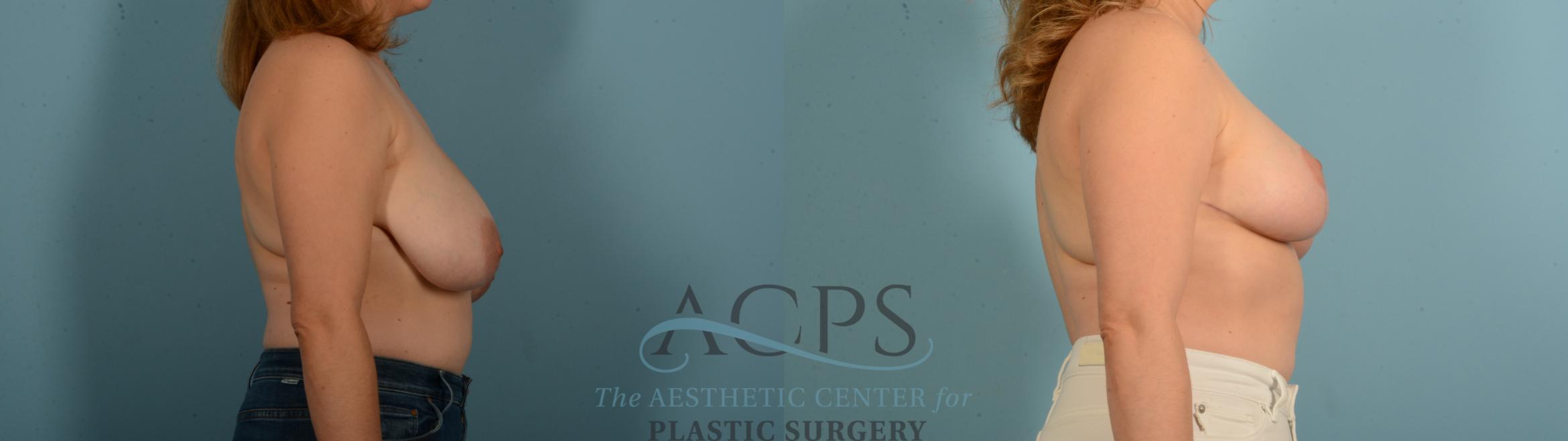 Before & After Breast Reduction Case 1543 Right Side View in Houston, TX