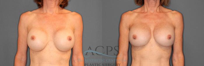 Before & After Breast Revision Case 1046 Front View: View in Houston, TX