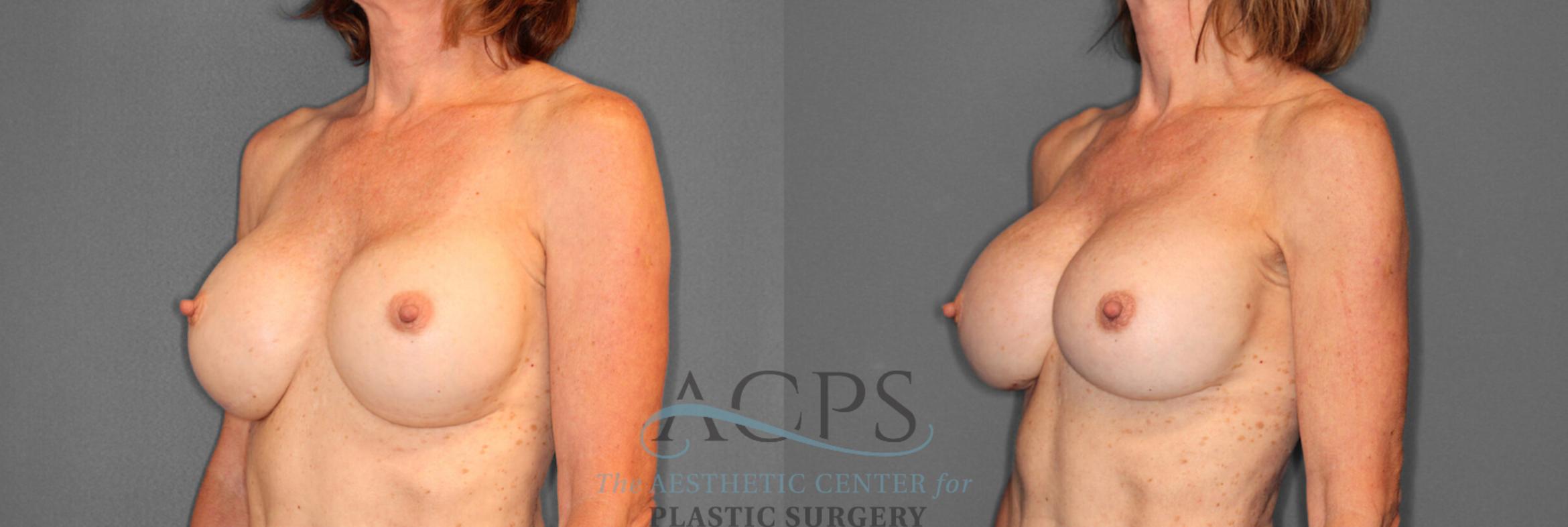 Before & After Breast Revision Case 1046 Oblique View: View in Houston, TX