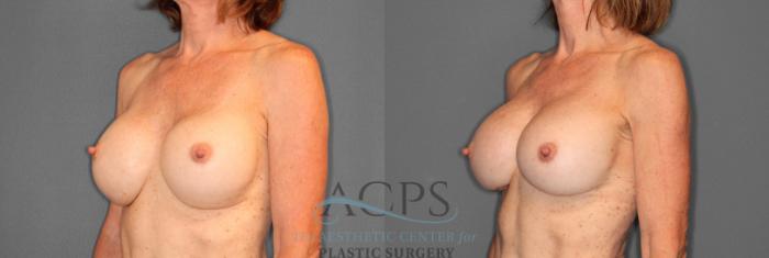 Before & After Breast Revision Case 1046 Oblique View: View in Houston, TX