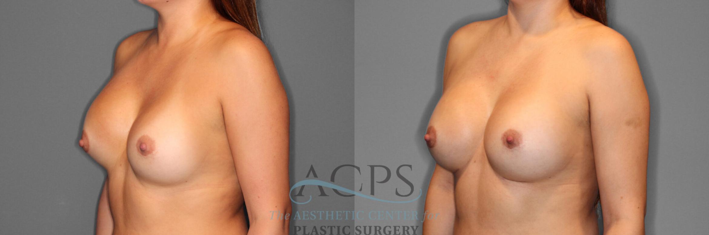 Before & After Breast Revision Case 1047 Oblique View: View in Houston, TX
