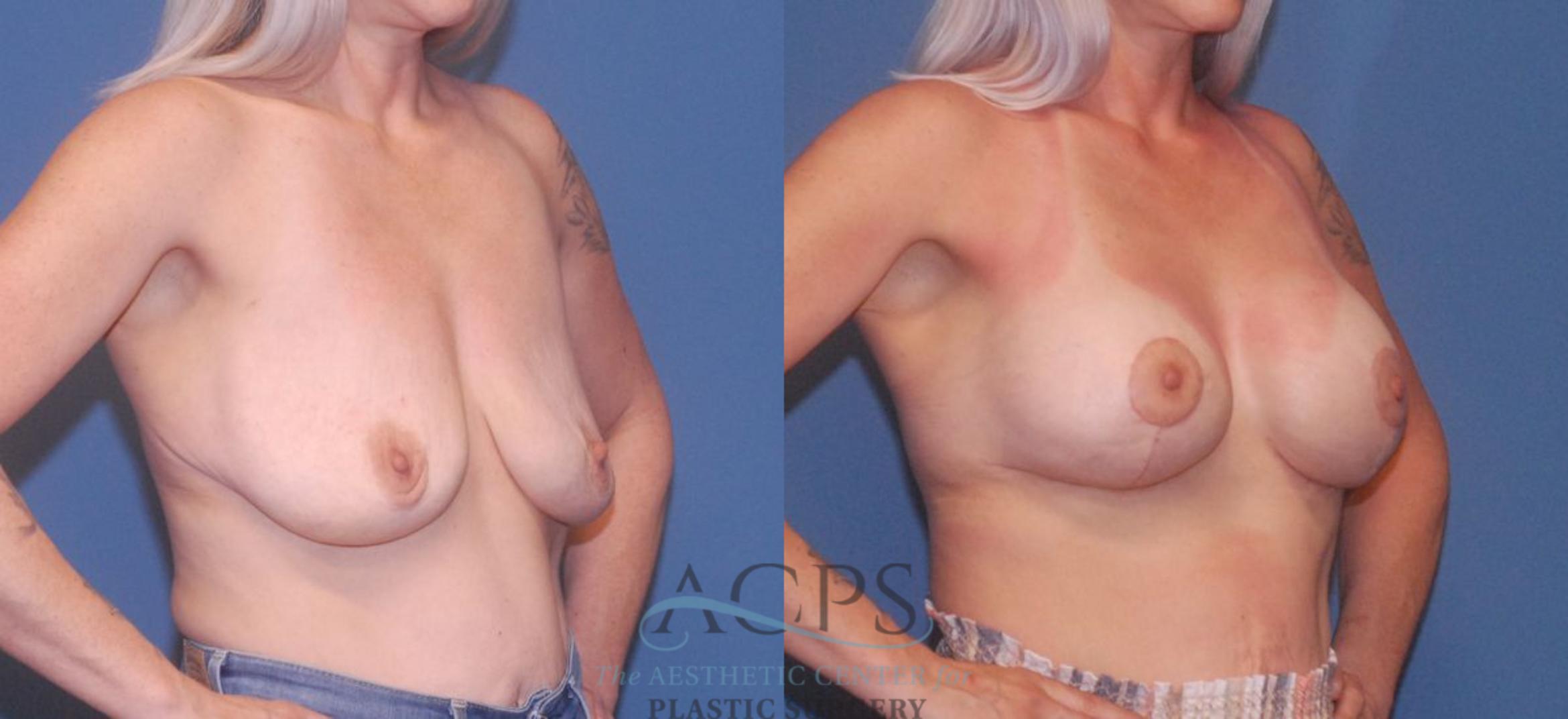Before & After Breast Revision Case 1048 Oblique View: View in Houston, TX