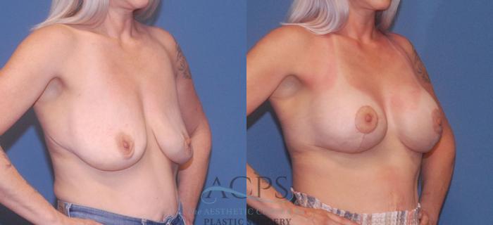 Before & After Breast Revision Case 1048 Oblique View: View in Houston, TX