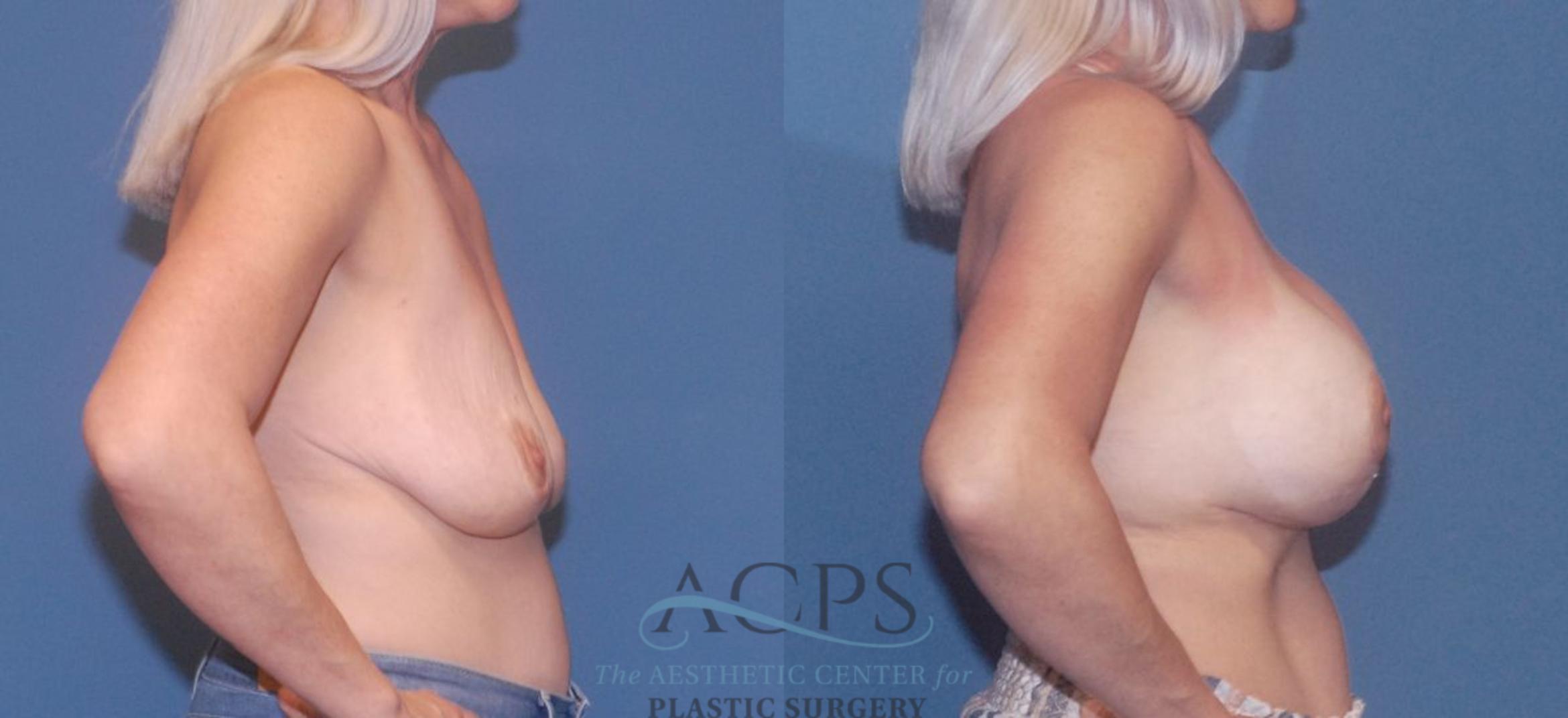 Before & After Breast Revision Case 1048 Right Side View: View in Houston, TX