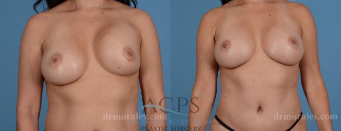 Before & After Breast Revision Case 1049 Front View: View in Houston, TX