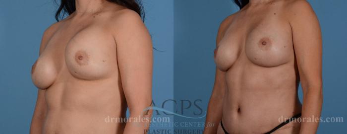 Before & After Breast Revision Case 1049 Oblique View: View in Houston, TX