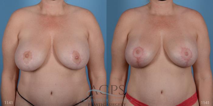 Before & After Breast Revision Case 1050 Front View: View in Houston, TX