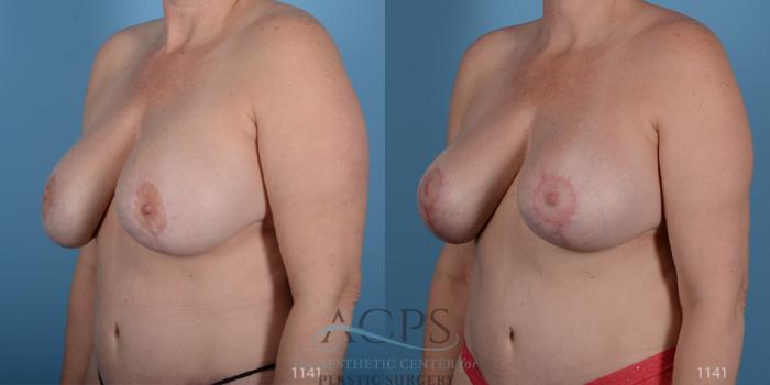 Before & After Breast Revision Case 1050 Oblique View: View in Houston, TX