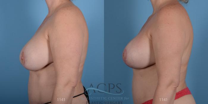 Before & After Breast Revision Case 1050 Side View: View in Houston, TX