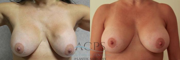 Before & After Breast Revision Case 1051 Front View: View in Houston, TX