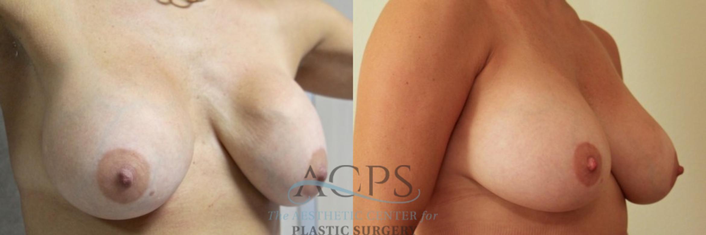 Before & After Breast Revision Case 1051 Oblique View: View in Houston, TX