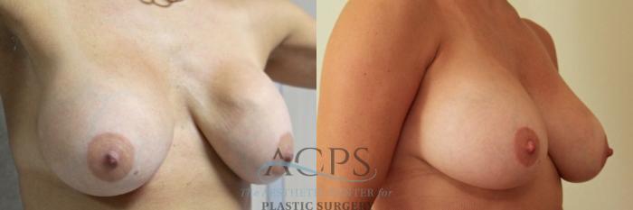 Before & After Breast Revision Case 1051 Oblique View: View in Houston, TX
