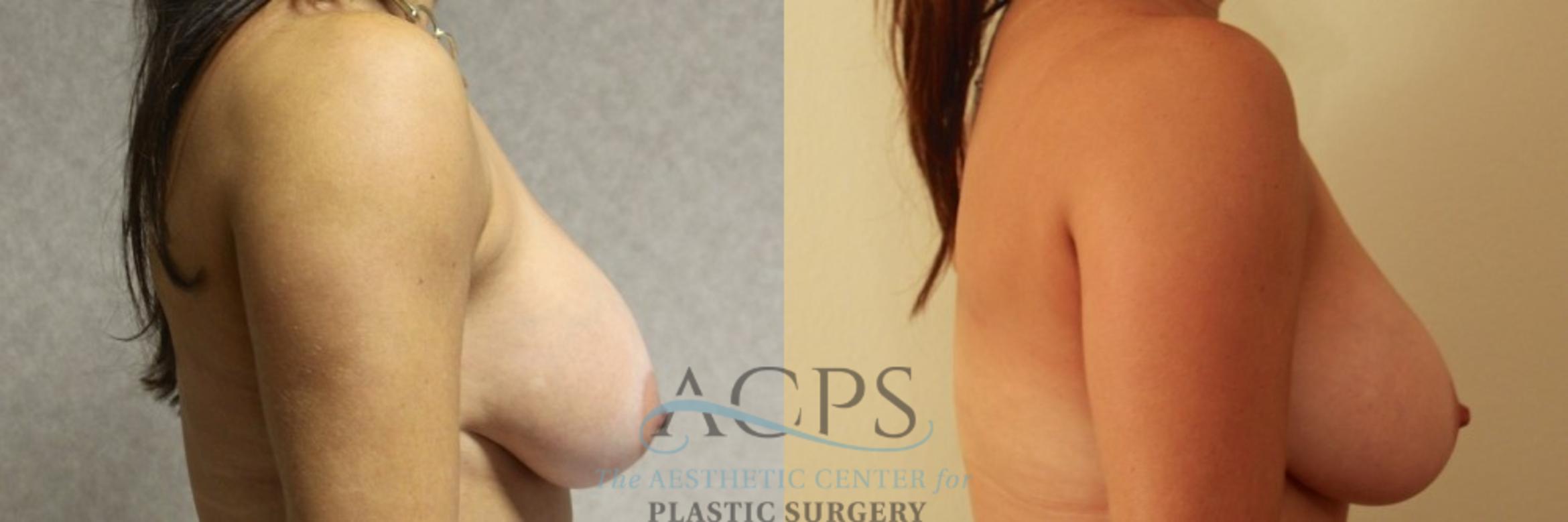 Before & After Breast Revision Case 1051 Side View: View in Houston, TX