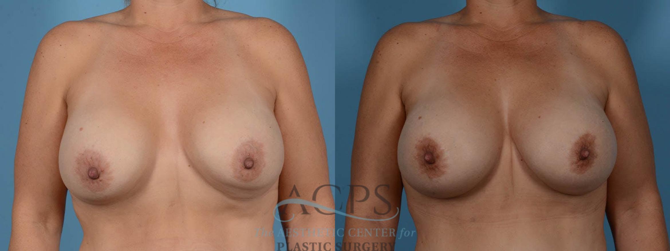 Before & After Breast Revision Case 1052 Front View: View in Houston, TX