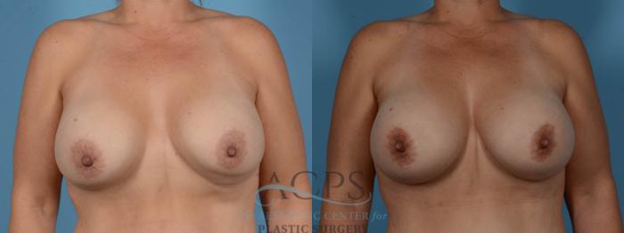 Before & After Breast Revision Case 1052 Front View: View in Houston, TX