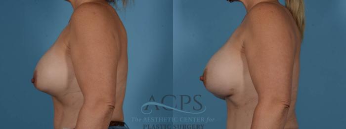 Before & After Breast Revision Case 1052 Left Side View: View in Houston, TX