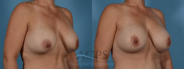 Before & After Breast Revision Case 1052 Oblique View: View in Houston, TX